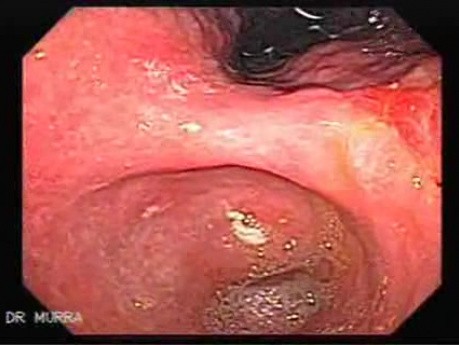 Adenocarcinoma of the Antrum (1 of 3)