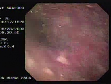 Esophageal Achalasia - 75 Year-Old Female