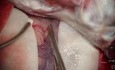 Sylvian Fissure Dissection