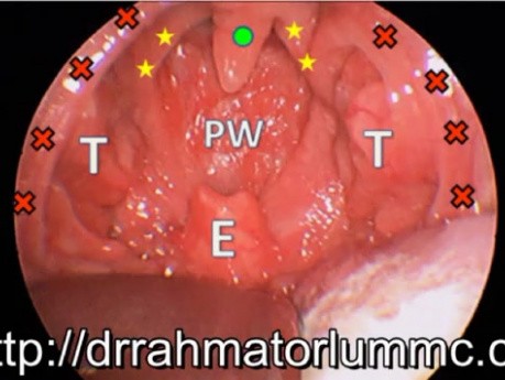 Paediatric Obstructive Sleep Apnea Syndrome (OSA) - Significantly Elongated Uvula and Obstructive Adenoid