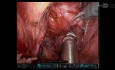 Successful Robotic Excision of a 6 cm Presacral Mass with Same Day Discharge