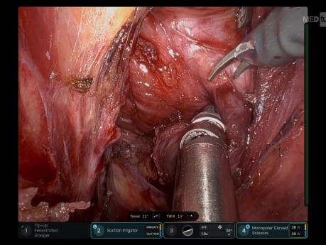 Successful Robotic Excision of a 6 cm Presacral Mass with Same Day Discharge