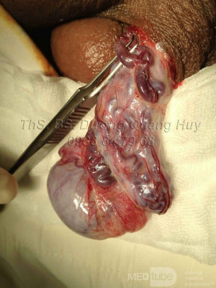 Varicocele