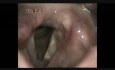 Intracordal Cyst (2)