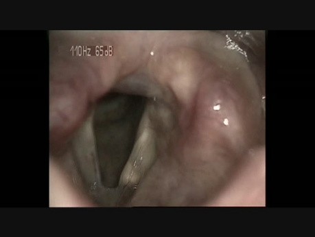 Intracordal Cyst (2)
