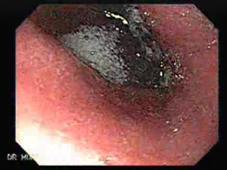 Gastric Lymphoma - Presence of the Ulcerated Mass