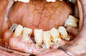 Dental Calculus
