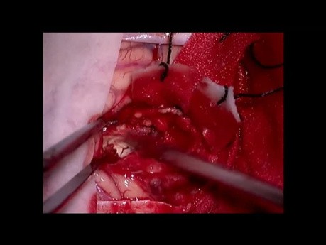 Cerebral metastasis