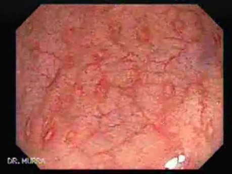 Crohn´s Colitis (1 of 3)