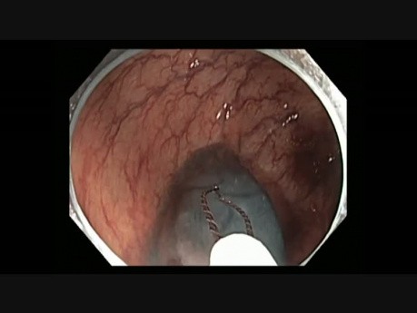 Colonoscopy Channel - EMR of a Subtle Lesion in the Ascending Colon