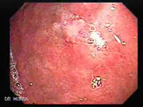 Systemic Lupus Erythematosus - Stomach finding (2 of 7)