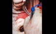 Myomectomy of a Case of Multiple Fibroid in a Young Lady