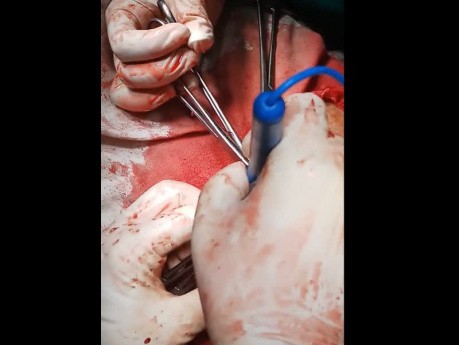 Myomectomy of a Case of Multiple Fibroid in a Young Lady