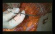 Right Open Hemicolectomy – Technical Principles - Part 3