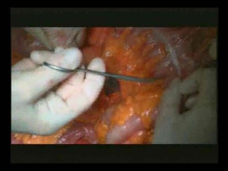 Right Open Hemicolectomy – Technical Principles - Part 3