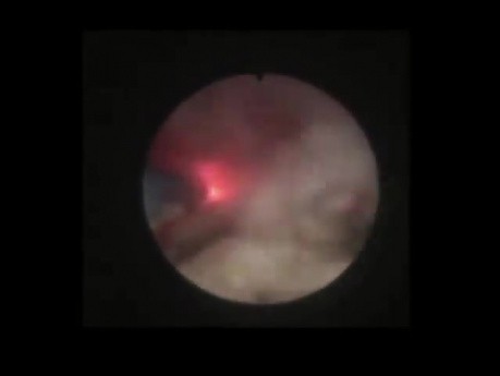 Retrograde Intrarenal Surgery - Ureteropelvic Junction Stone