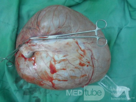 Huge left ovarian cyst 2