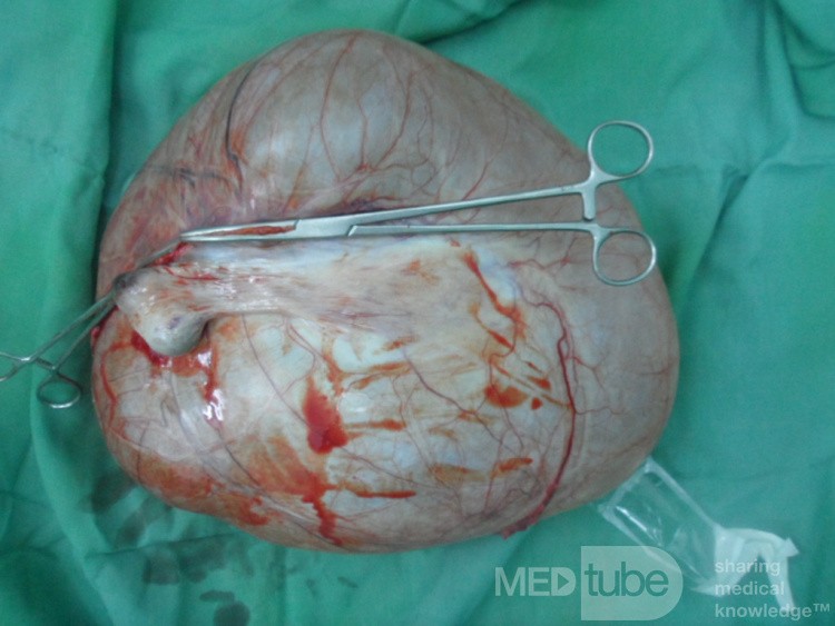 Huge left ovarian cyst 2