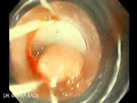 Upper GI Bleeding Due to Esophageal Varices - Banding