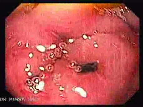 Erosions Of The Pre-piloric Antrum - Gastroscopy