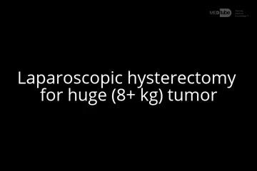 Laparoscopic Hysterectomy for Huge 8+ kg Tumor
