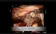 Robot assisted mitral valve repair with neochords, leaflet plasty and annuloplasty along with closure of PFO and left atrial appendage