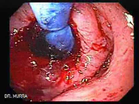 Esophagus - Pneumatic Dilation for Achalasia - Status Post Dilation