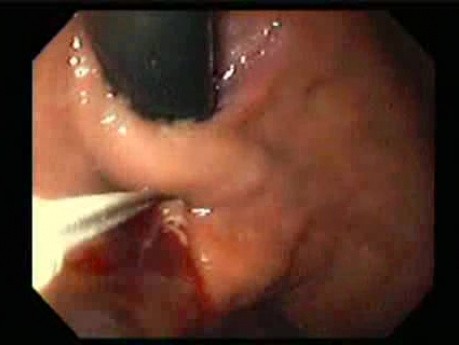 Gastric Varices - Endoscopic Ablation With Cyanoacrylate Glue (7 of 18)