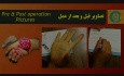 Replantation Case 3