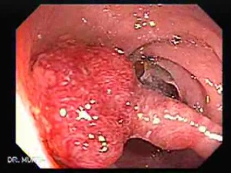Endoscopic Appearance of Pedicled Polyp of the Descending Colon (3 of 7)