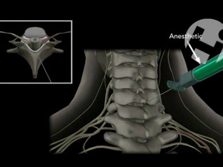 Epidural Steroid Injection