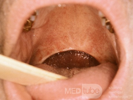 Uvulopalatoplasty