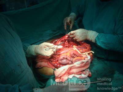 Mesenteric Ischemia (6 of 12)