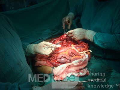 Mesenteric Ischemia (6 of 12)