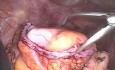 Laparoscopic Total Colectomy with Ileorectal Anastomosis for Colonic Inertia