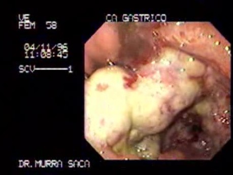 Gastric Adenocarcinoma With Central Necrosis - Endoscopy