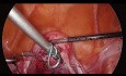 Laparoscopic Hysterosacropexy