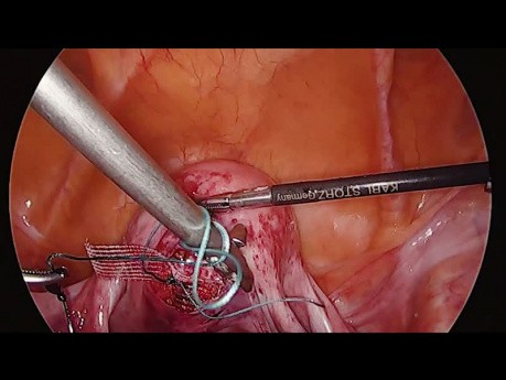Laparoscopic Hysterosacropexy