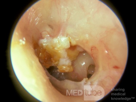 Cholesteatoma