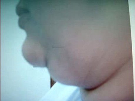 Double chin - plastic surgery
