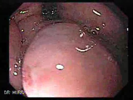 Large Gastric Varices (1 of 4)