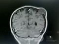 Epicranial Tumor Injury