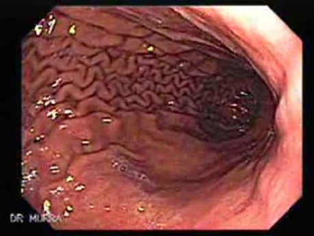 Gastric Folds - Endoscopic Image