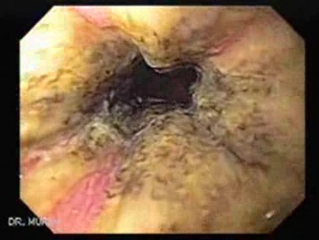 The Black Esophagus - 70 Years-Old Male