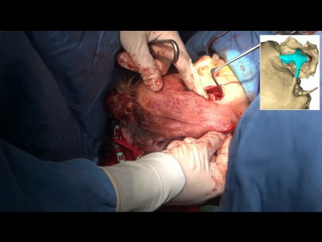 Secondary Zygomatic Osteotomy and Reconstruction with Peek Implant