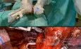 Robotic Surgery for Lung Cancer 