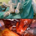 Robotic Surgery for Lung Cancer 
