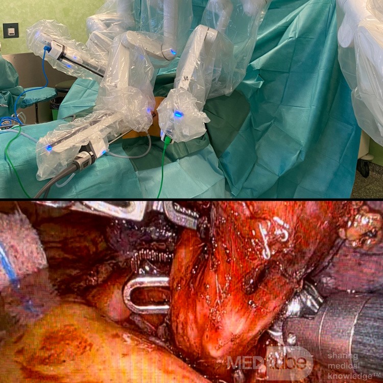 Robotic Surgery for Lung Cancer 