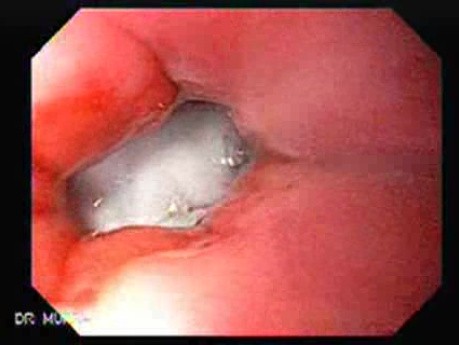 Intragastric Balloon - The Treatment Of Obesity (13 of 13)