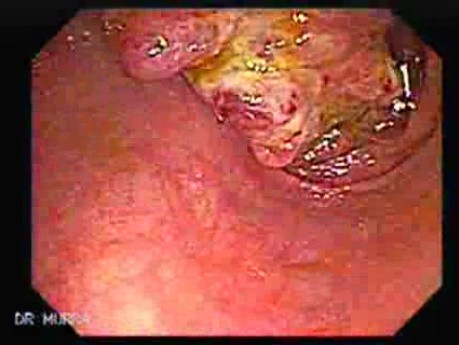 Cecum Adenocarcinoma (2 of 2)